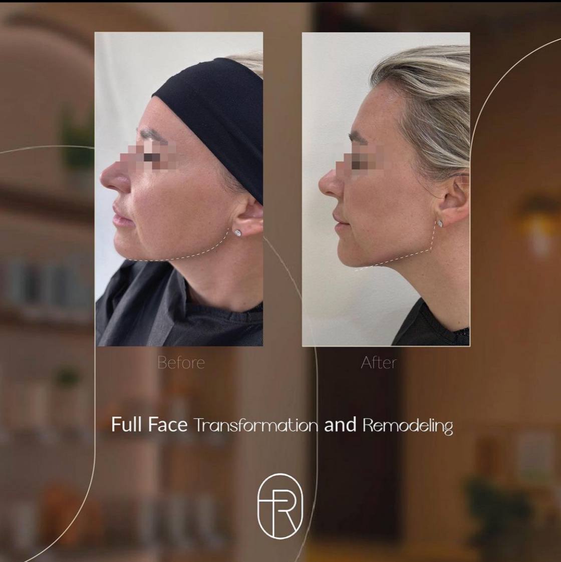 Before After - Full Face Remodeling