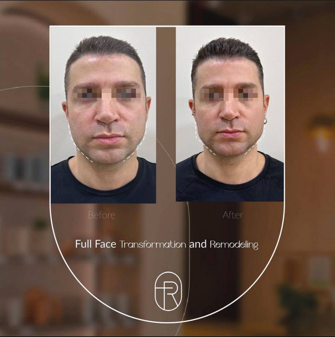 Before After - Full Face Transformation