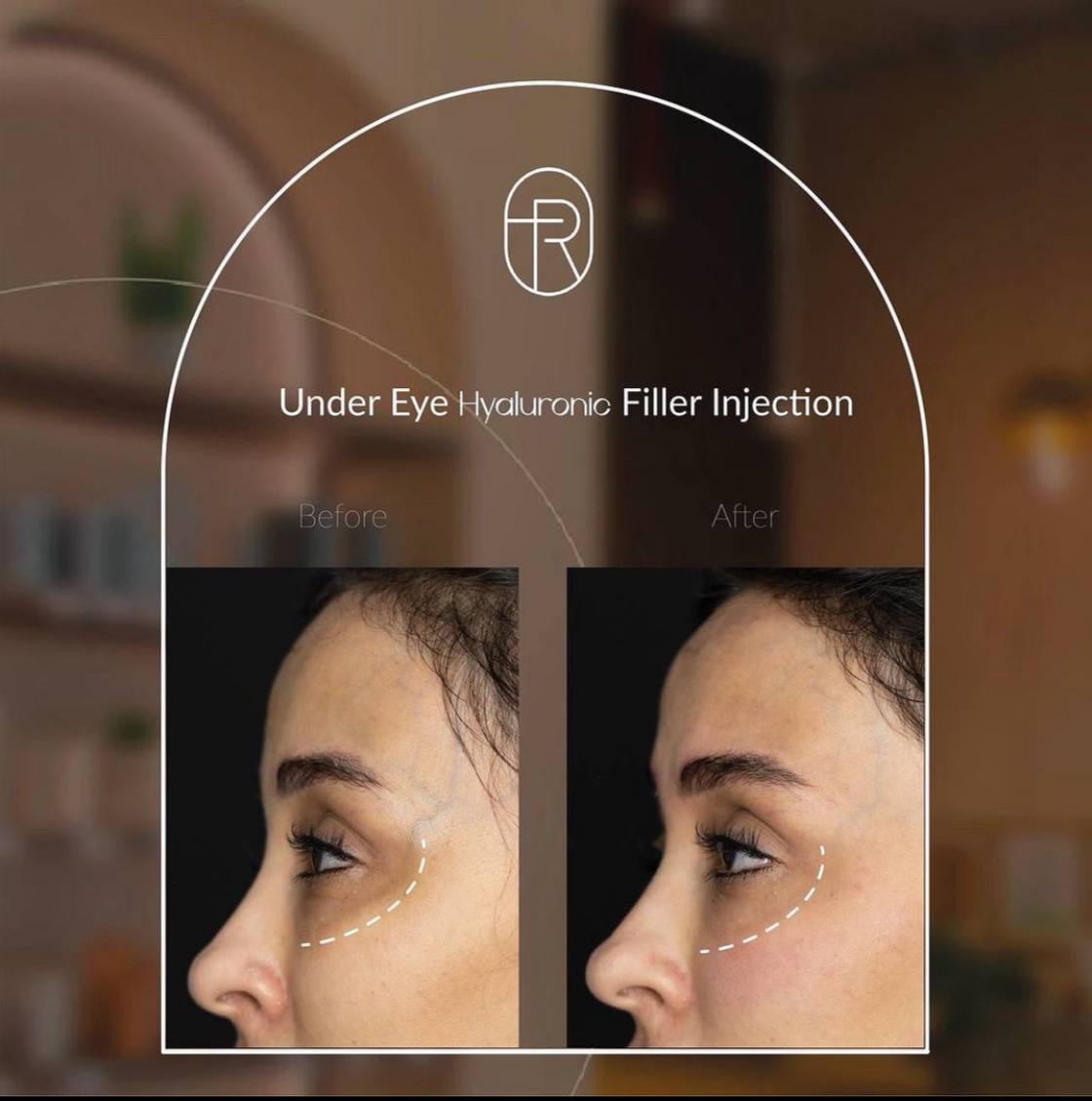 Before After - under eye Hyaluronic Filler