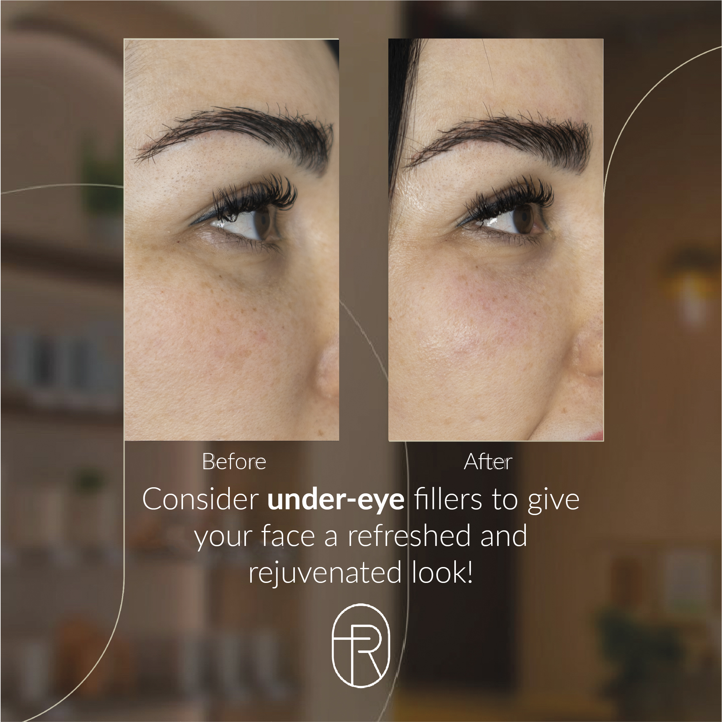 Before After - under-eye