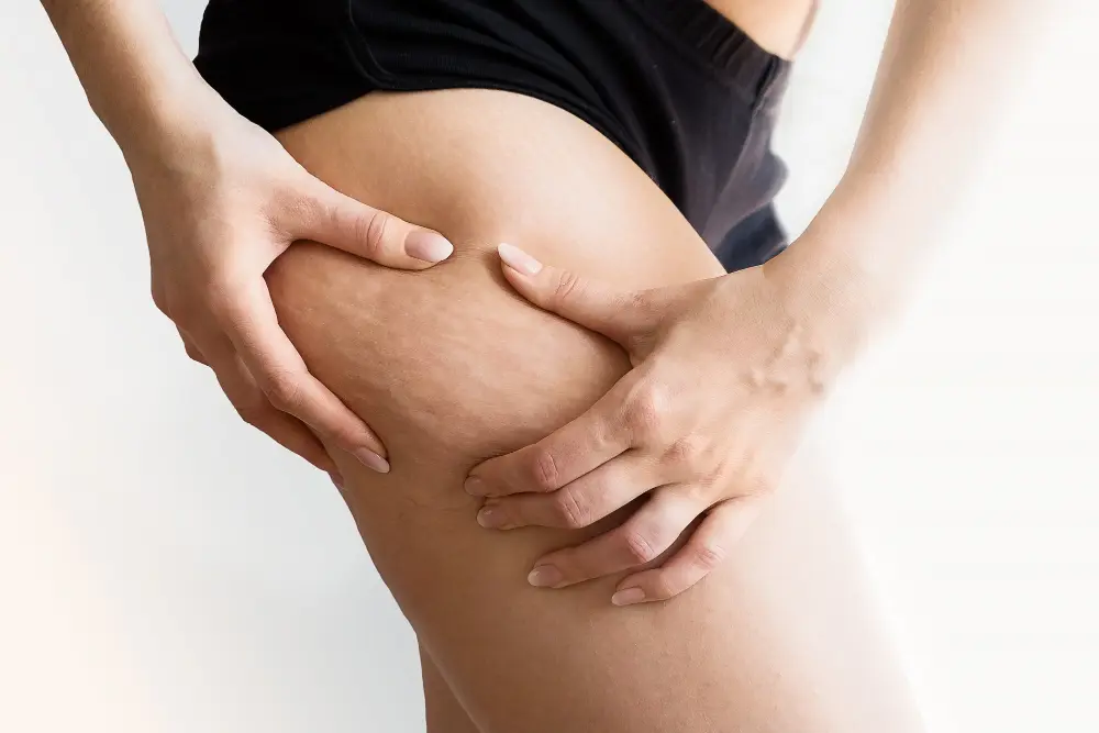 cellulite treatment dubai