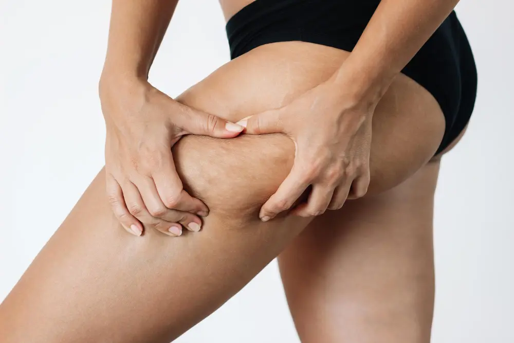 cellulite treatment dubai