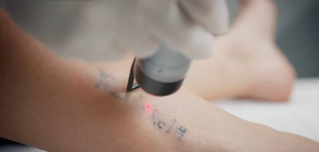 Tattoo Removal in Dubai