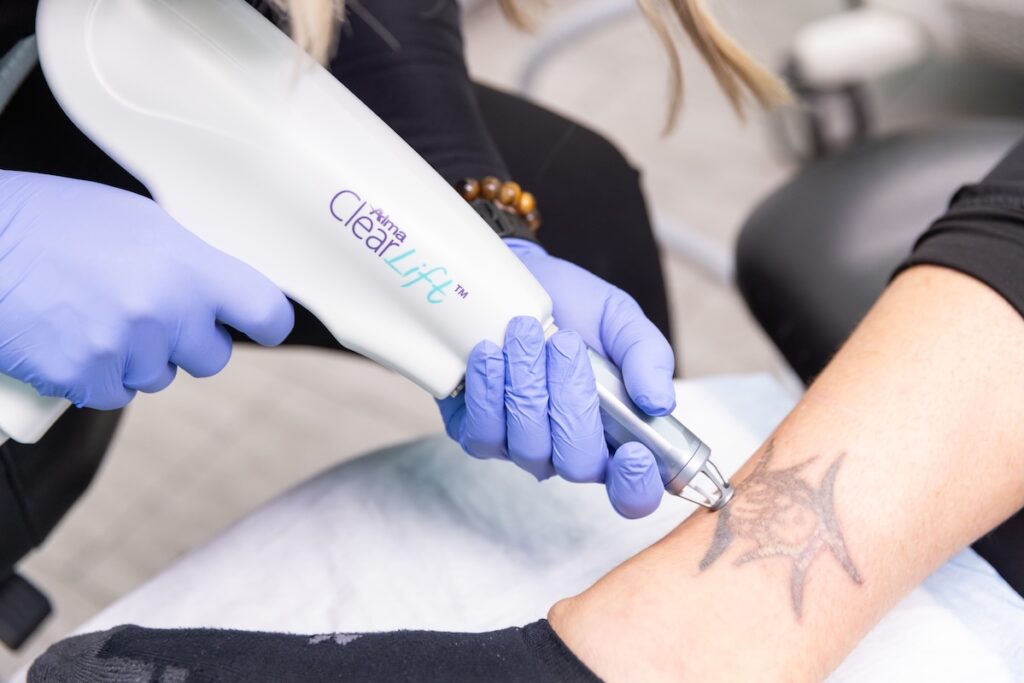 Tattoo Removal in Dubai