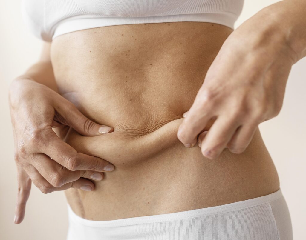 abdominoplasty