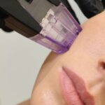 How Many Morpheus8 Sessions Do You Need for Visible Results?