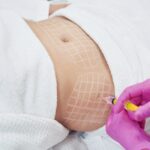 Non-Surgical Body Contouring: Is Filler the Future?