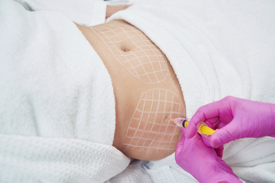 Non-surgical body contouring with fillers - Reformery Aesthetics Clinic