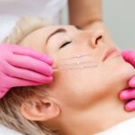 Can Thread Lifts Improve Jawline and Sagging Skin?