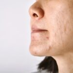 The Best Treatments for Acne Scars in Dubai: What Really Works?