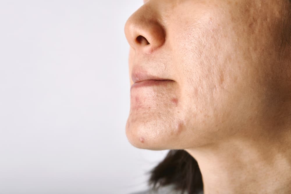 Acne Scar Treatment Dubai