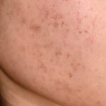 Best Acne-Scar Treatments in Dubai: Laser, Subcision or Microneedling?