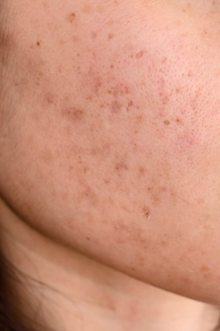 acne scar treatment in Dubai