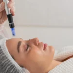 Exosome Microneedling: Benefits, Downtime and What Results to Expect