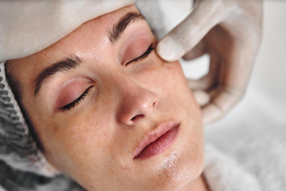 IPL for redness or pigmentation