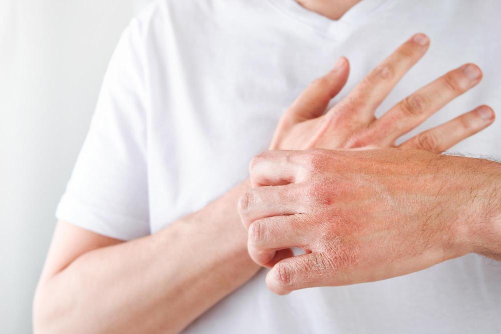 eczema or dry skin