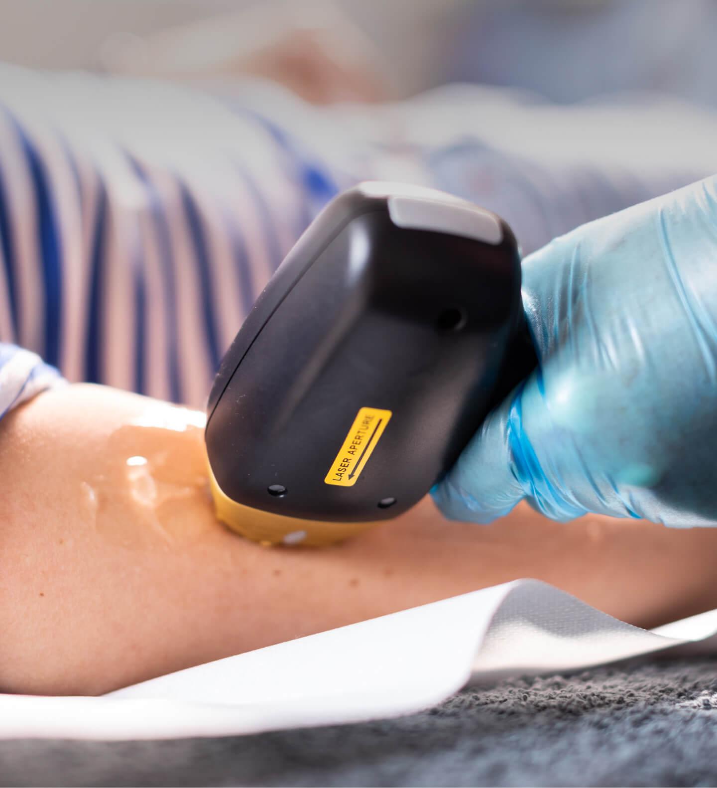 laser hair removal aftercare Dubai