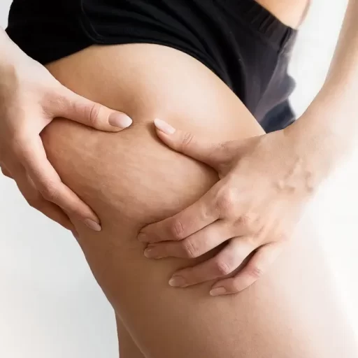 cellulite treatment dubai cellulite treatment dubai